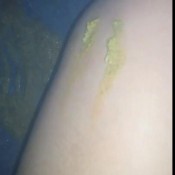 cleopatrax19 i have a lot of diarrhea and i can`t stand to explode in the shower !!!